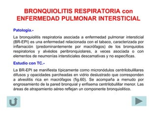 BRONQUIOLITIS RESPIRATORIA con
ENFERMEDAD PULMONAR INTERSTICIAL
Patología.-
La bronquiolitis respiratoria asociada a enfermedad pulmonar intersticial
(BR-EPI) es una enfermedad relacionada con el tabaco, caracterizada por
inflamación (predominantemente por macrófagos) de los bronquiolos
respiratorios y alvéolos peribronquiolares, a veces asociada o con
elementos de neumonías intersticiales descamativas y no específicas.
Estudio con TC.-
La BR-EPI se manifiesta típicamente como micronódulos centrilobulillares
difusos y opacidades parcheadas en vidrio deslustrado que corresponden
a alveolitis rica en macrófagos (fig.60). Se acompaña a menudo por
engrosamiento de la pared bronquial y enfisema centrilobulillar menor. Las
áreas de atrapamiento aéreo reflejan un componente bronquiolitico.
 