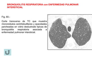 BRONQUIOLITIS RESPIRATORIA con ENFERMEDAD PULMONAR
INTERSTICIAL
Fig. 60.-
Corte transverso de TC que muestra
micronódulos centrilobulillares y opacidades
parcheadas en vidrio deslustrado tipicas de
bronquiolitis respiratoria asociada a
enfermedad pulmonar intersticial.
 