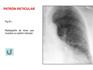PATRÓN RETICULAR
Fig.61.-
Radiografía de tórax que
muestra un patrón reticular.
 