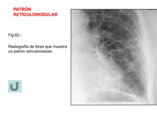 PATRÓN
RETÍCULONODULAR
Fig.62.-
Radiografía de tórax que muestra
un patrón retículonodular.
 