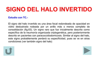 SIGNO DEL HALO INVERTIDO
Estudio con TC.-
El signo del halo invertido es una área focal redondeada de opacidad en
vidrio deslustrado rodeada por un anillo más o menos completo de
consolidación (fig.63). Un signo raro que fue inicialmente descrito como
específico de la neumonía organizada criptogenética, pero posteriormente
descrito en pacientes con paracoccidiodomicosis. Similar al signo del halo,
este signo probablemente perderá su especificidad, pues se ve en otras
condiciones (ver también signo del halo)
 