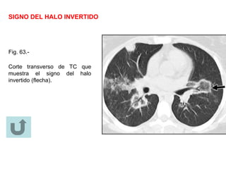 SIGNO DEL HALO INVERTIDO
Fig. 63.-
Corte transverso de TC que
muestra el signo del halo
invertido (flecha).
 