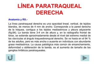 LÍNEA PARATRAQUEAL
DERECHA
Anatomía y RX.-
La línea paratraqueal derecha es una opacidad lineal, vertical, de tejidos
blandos, de menos de 4 mm de ancho. Corresponde a la pared derecha
de la tráquea, contigua a los tejidos mediastinicos y pleura adyacente
(fig.64). La banda tiene 3-4 cm de altura y, en la radiografía frontal de
tórax, se extiende aproximadamente desde el nivel del extremo medial de
las clavículas al ángulo traqueobronquial derecho. Se ve hasta en el 94 %
de los adultos, pero es más ancha o ausente en individuos con abundante
grasa mediastinica. La causa patológica más común de ensanchamiento,
deformidad u obliteración de la banda, es el aumento de tamaño de los
ganglios linfáticos paratraqueales.
 