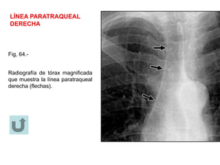 LÍNEA PARATRAQUEAL
DERECHA
Fig, 64.-
Radiografía de tórax magnificada
que muestra la línea paratraqueal
derecha (flechas).
 