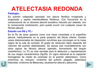 ATELECTASIA REDONDA
Patología.-
Es pulmón colapsado asociado con pleura fibrótica invaginada y
engrosada y septos interlobulillares fibróticos. Con frecuencia es la
consecuencia de un derrame pleural exudativo inducido por asbesto, con
la consecuente cicatrización, pero puede ocurrir con cualquier causa de
fibrosis pleural.
Estudio con RX y TC.-
En la Rx de tórax aparece como una masa conectada a la superficie
pleural, habitualmente en la parte posterior del lóbulo inferior. Existen
vasos distorsionados de disposición curvilínea que convergen en la masa
(signo de la cola de cometa). El grado de retracción lobar depende del
volumen del pulmón atelectasiado. Se asocia casi invariablemente con
otros signos de fibrosis pleural (ejemplo, borramiento del ángulo
costofrénico). La TC es más sensible para la detección y representación
de sus rasgos característicos (fig.65). Un signo adicional es la captación
homogénea de medio de contraste en el pulmón atelectásico. Como
sinónimos se incluyen: síndrome del pulmón plegado, atelectasia
helicoidal, síndrome de Blesovsky, seudotumor pleural y pleuroma.
 