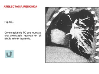 ATELECTASIA REDONDA
Fig. 65.-
Corte sagital de TC que muestra
una atelectasia redonda en el
lóbulo inferior izquierdo.
 