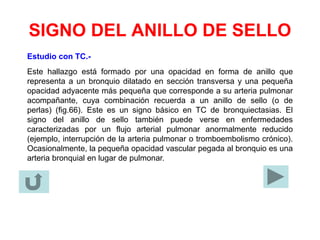 SIGNO DEL ANILLO DE SELLO
Estudio con TC.-
Este hallazgo está formado por una opacidad en forma de anillo que
representa a un bronquio dilatado en sección transversa y una pequeña
opacidad adyacente más pequeña que corresponde a su arteria pulmonar
acompañante, cuya combinación recuerda a un anillo de sello (o de
perlas) (fig.66). Este es un signo básico en TC de bronquiectasias. El
signo del anillo de sello también puede verse en enfermedades
caracterizadas por un flujo arterial pulmonar anormalmente reducido
(ejemplo, interrupción de la arteria pulmonar o tromboembolismo crónico).
Ocasionalmente, la pequeña opacidad vascular pegada al bronquio es una
arteria bronquial en lugar de pulmonar.
 