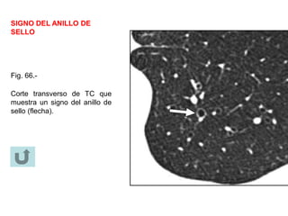 SIGNO DEL ANILLO DE
SELLO
Fig. 66.-
Corte transverso de TC que
muestra un signo del anillo de
sello (flecha).
 