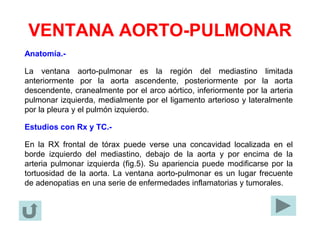 VENTANA AORTO-PULMONAR
Anatomía.-
La ventana aorto-pulmonar es la región del mediastino limitada
anteriormente por la aorta ascendente, posteriormente por la aorta
descendente, cranealmente por el arco aórtico, inferiormente por la arteria
pulmonar izquierda, medialmente por el ligamento arterioso y lateralmente
por la pleura y el pulmón izquierdo.
Estudios con Rx y TC.-
En la RX frontal de tórax puede verse una concavidad localizada en el
borde izquierdo del mediastino, debajo de la aorta y por encima de la
arteria pulmonar izquierda (fig.5). Su apariencia puede modificarse por la
tortuosidad de la aorta. La ventana aorto-pulmonar es un lugar frecuente
de adenopatias en una serie de enfermedades inflamatorias y tumorales.
 