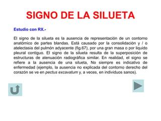 SIGNO DE LA SILUETA
Estudio con RX.-
El signo de la silueta es la ausencia de representación de un contorno
anatómico de partes blandas. Está causado por la consolidación y / o
atelectasia del pulmón adyacente (fig.67), por una gran masa o por liquido
pleural contiguo. El signo de la silueta resulta de la superposición de
estructuras de atenuación radiográfica similar. En realidad, el signo se
refiere a la ausencia de una silueta, No siempre es indicativo de
enfermedad (ejemplo, la ausencia no explicada del contorno derecho del
corazón se ve en pectus excavatum y, a veces, en individuos sanos).
 