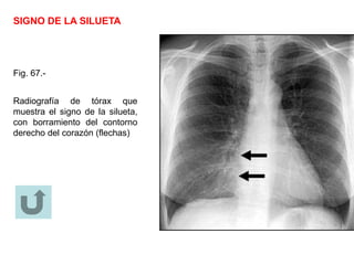 SIGNO DE LA SILUETA
Fig. 67.-
Radiografía de tórax que
muestra el signo de la silueta,
con borramiento del contorno
derecho del corazón (flechas)
 