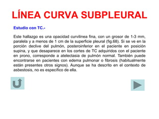 LÍNEA CURVA SUBPLEURAL
Estudio con TC.-
Este hallazgo es una opacidad curvilinea fina, con un grosor de 1-3 mm,
paralela y a menos de 1 cm de la superficie pleural (fig.68). Si se ve en la
porción declive del pulmón, posteroinferior en el paciente en posición
supina, y que desaparece en los cortes de TC adquiridos con el paciente
en prono, corresponde a atelectasia de pulmón normal. También puede
encontrarse en pacientes con edema pulmonar o fibrosis (habitualmente
están presentes otros signos). Aunque se ha descrito en el contexto de
asbestosis, no es específico de ella.
 