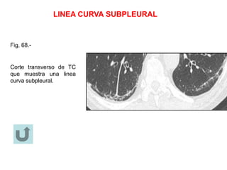 LINEA CURVA SUBPLEURAL
Fig, 68.-
Corte transverso de TC
que muestra una linea
curva subpleural.
 