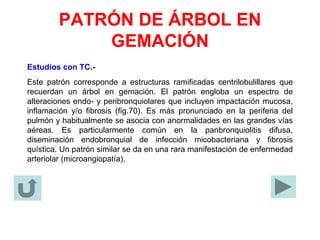 PATRÓN DE ÁRBOL EN
GEMACIÓN
Estudios con TC.-
Este patrón corresponde a estructuras ramificadas centrilobulillares que
recuerdan un árbol en gemación. El patrón engloba un espectro de
alteraciones endo- y peribronquiolares que incluyen impactación mucosa,
inflamación y/o fibrosis (fig.70). Es más pronunciado en la periferia del
pulmón y habitualmente se asocia con anormalidades en las grandes vías
aéreas. Es particularmente común en la panbronquiolitis difusa,
diseminación endobronquial de infección micobacteriana y fibrosis
quística. Un patrón similar se da en una rara manifestación de enfermedad
arteriolar (microangiopatía).
 