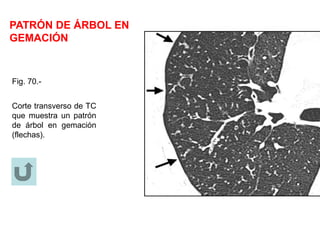 PATRÓN DE ÁRBOL EN
GEMACIÓN
Fig. 70.-
Corte transverso de TC
que muestra un patrón
de árbol en gemación
(flechas).
 