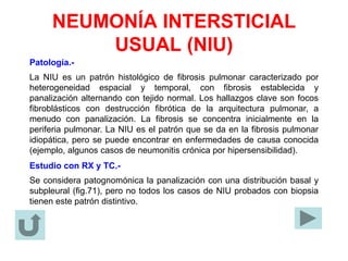 NEUMONÍA INTERSTICIAL
USUAL (NIU)
Patología.-
La NIU es un patrón histológico de fibrosis pulmonar caracterizado por
heterogeneidad espacial y temporal, con fibrosis establecida y
panalización alternando con tejido normal. Los hallazgos clave son focos
fibroblásticos con destrucción fibrótica de la arquitectura pulmonar, a
menudo con panalización. La fibrosis se concentra inicialmente en la
periferia pulmonar. La NIU es el patrón que se da en la fibrosis pulmonar
idiopática, pero se puede encontrar en enfermedades de causa conocida
(ejemplo, algunos casos de neumonitis crónica por hipersensibilidad).
Estudio con RX y TC.-
Se considera patognomónica la panalización con una distribución basal y
subpleural (fig.71), pero no todos los casos de NIU probados con biopsia
tienen este patrón distintivo.
 