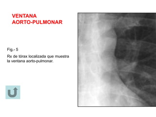 VENTANA
AORTO-PULMONAR
Fig.- 5
Rx de tórax localizada que muestra
la ventana aorto-pulmonar.
 