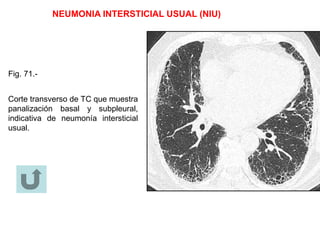 NEUMONIA INTERSTICIAL USUAL (NIU)
Fig. 71.-
Corte transverso de TC que muestra
panalización basal y subpleural,
indicativa de neumonía intersticial
usual.
 