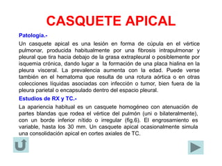 CASQUETE APICAL
Patología.-
Un casquete apical es una lesión en forma de cúpula en el vértice
pulmonar, producida habitualmente por una fibrosis intrapulmonar y
pleural que tira hacia debajo de la grasa extrapleural o posiblemente por
isquemia crónica, dando lugar a la formación de una placa hialina en la
pleura visceral. La prevalencia aumenta con la edad. Puede verse
también en el hematoma que resulta de una rotura aórtica o en otras
colecciones líquidas asociadas con infección o tumor, bien fuera de la
pleura parietal o encapsulado dentro del espacio pleural.
Estudios de RX y TC.-
La apariencia habitual es un casquete homogéneo con atenuación de
partes blandas que rodea el vértice del pulmón (uni o bilateralmente),
con un borde inferior nítido o irregular (fig.6). El engrosamiento es
variable, hasta los 30 mm. Un casquete apical ocasionalmente simula
una consolidación apical en cortes axiales de TC.
 