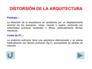 DISTORSIÓN DE LA ARQUITECTURA
Patología .-
La distorsión de la arquitectura se caracteriza por un desplazamiento
anormal de los bronquios, vasos, cisuras o septos, producido por
enfermedad pulmonar localizada o difusa, particularmente fibrosis
intersticial.
Cortes de TC .-
La anatomía pulmonar tiene una apariencia distorsionada y se asocia
habitualmente con fibrosis pulmonar (fig.7), acompañada de pérdida de
volumen.
 