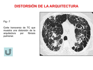 DISTORSIÓN DE LA ARQUITECTURA
Fig.- 7
Corte transverso de TC que
muestra una distorsión de la
arquitectura por fibrosis
pulmonar.
 