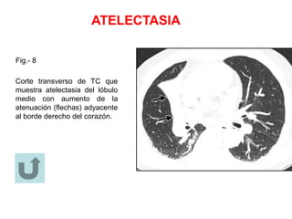 ATELECTASIA
Fig.- 8
Corte transverso de TC que
muestra atelectasia del lóbulo
medio con aumento de la
atenuación (flechas) adyacente
al borde derecho del corazón.
 