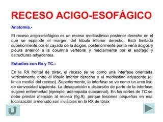 RECESO ACIGO-ESOFÁGICO
Anatomía.-
El receso acigo-esofágico es un receso mediastínico posterior derecho en el
que se expande el margen del lóbulo inferior derecho. Está limitado
superiormente por el cayado de la ácigos, posteriormente por la vena ácigos y
pleura anterior a la columna vertebral y medialmente por el esófago y
estructuras adyacentes.
Estudios con Rx y TC.-
En la RX frontal de tórax, el receso se ve como una interfase orientada
verticalmente entre el lóbulo inferior derecho y el mediastino adyacente (el
límite medial del receso). Superiormente, la interfase se ve como un arco liso
de convexidad izquierda. La desaparición o distorsión de parte de la interfase
sugiere enfermedad (ejemplo, adenopatia subcarinal). En los cortes de TC se
debe prestar atención al receso (fig.9), porque lesiones pequeñas en esa
localización a menudo son invisibles en la RX de tórax
 