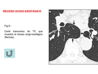 RECESO ACIGO-ESOFÁGICO
Fig.9.-
Corte transverso de TC que
muestra el receso acigo-esofágico
(flechas).
 