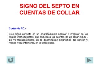 SIGNO DEL SEPTO EN
CUENTAS DE COLLAR
Cortes de TC.-
Este signo consiste en un engrosamiento nodular e irregular de los
septos interlobulillares, que remeda a las cuentas de un collar (fig.10).
Se ve frecuentemente en la diseminación linfangítica del cáncer y,
menos frecuentemente, en la sarcoidosis.
 