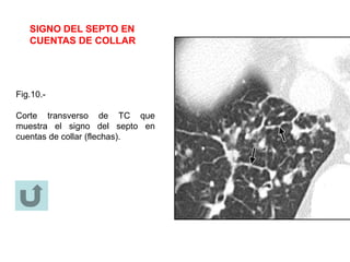 SIGNO DEL SEPTO EN
CUENTAS DE COLLAR
Fig.10.-
Corte transverso de TC que
muestra el signo del septo en
cuentas de collar (flechas).
 