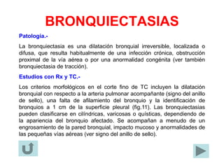 BRONQUIECTASIAS
Patología.-
La bronquiectasia es una dilatación bronquial irreversible, localizada o
difusa, que resulta habitualmente de una infección crónica, obstrucción
proximal de la vía aérea o por una anormalidad congénita (ver también
bronquiectasia de tracción).
Estudios con Rx y TC.-
Los criterios morfológicos en el corte fino de TC incluyen la dilatación
bronquial con respecto a la arteria pulmonar acompañante (signo del anillo
de sello), una falta de afilamiento del bronquio y la identificación de
bronquios a 1 cm de la superficie pleural (fig.11). Las bronquiectasias
pueden clasificarse en cilíndricas, varicosas o quísticas, dependiendo de
la apariencia del bronquio afectado. Se acompañan a menudo de un
engrosamiento de la pared bronquial, impacto mucoso y anormalidades de
las pequeñas vías aéreas (ver signo del anillo de sello).
 