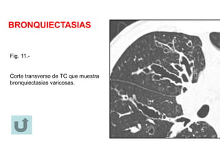 BRONQUIECTASIAS
Fig. 11.-
Corte transverso de TC que muestra
bronquiectasias varicosas.
 