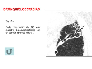 BRONQUIOLOECTASIAS
Fig.12.-
Corte transverso de TC que
muestra bronquioloectasias en
un pulmón fibrótico (flecha).
 