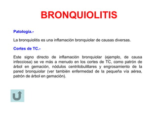 BRONQUIOLITIS
Patología.-
La bronquiolitis es una inflamación bronquiolar de causas diversas.
Cortes de TC.-
Este signo directo de inflamación bronquiolar (ejemplo, de causa
infecciosa) se ve más a menudo en los cortes de TC, como patrón de
árbol en gemación, nódulos centrilobulillares y engrosamiento de la
pared bronquiolar (ver también enfermedad de la pequeña vía aérea,
patrón de árbol en gemación).
 