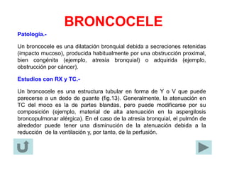 BRONCOCELE
Patología.-
Un broncocele es una dilatación bronquial debida a secreciones retenidas
(impacto mucoso), producida habitualmente por una obstrucción proximal,
bien congénita (ejemplo, atresia bronquial) o adquirida (ejemplo,
obstrucción por cáncer).
Estudios con RX y TC.-
Un broncocele es una estructura tubular en forma de Y o V que puede
parecerse a un dedo de guante (fig.13). Generalmente, la atenuación en
TC del moco es la de partes blandas, pero puede modificarse por su
composición (ejemplo, material de alta atenuación en la aspergilosis
broncopulmonar alérgica). En el caso de la atresia bronquial, el pulmón de
alrededor puede tener una disminución de la atenuación debida a la
reducción de la ventilación y, por tanto, de la perfusión.
 