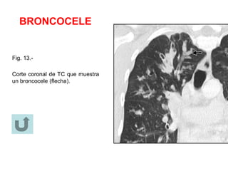 BRONCOCELE
Fig. 13.-
Corte coronal de TC que muestra
un broncocele (flecha).
 
