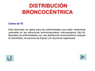 DISTRIBUCIÓN
BRONCOCÉNTRICA
Cortes de TC
Este descriptor se aplica para las enfermedades que están claramente
centradas en las estructuras broncovasculares macroscópicas (fig.14).
Ejemplos de enfermedades con una distribución broncocéntrica incluyen
la sarcoidosis, el sarcoma de Kaposi y la neumonía organizada.
 