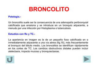 BRONCOLITO
Patología.-
Un broncolito suele ser la consecuencia de una adenopatía peribronquial
calcificada que erosiona y se introduce en un bronquio adyacente, a
menudo por una infección por Histoplasma o tuberculosis.
Estudios con Rx y TC.-
La apariencia en imagen es la de un pequeño foco calcificado en o
inmediatamente adyacente a una vía aérea (fig.15), más frecuentemente
el bronquio del lóbulo medio. Los broncolitos se identifican rápidamente
en los cortes de TC. Los cambios obstructivos distales pueden incluir
atelectasia, impacto mucoso y bronquiectasias.
 