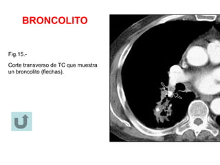 BRONCOLITO
Fig.15.-
Corte transverso de TC que muestra
un broncolito (flechas).
 