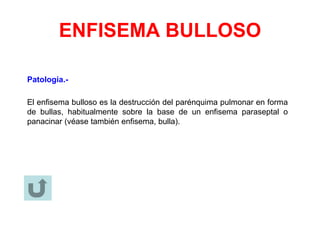 ENFISEMA BULLOSO
Patología.-
El enfisema bulloso es la destrucción del parénquima pulmonar en forma
de bullas, habitualmente sobre la base de un enfisema paraseptal o
panacinar (véase también enfisema, bulla).
 