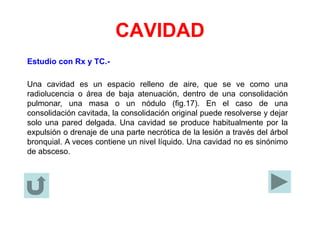 CAVIDAD
Estudio con Rx y TC.-
Una cavidad es un espacio relleno de aire, que se ve como una
radiolucencia o área de baja atenuación, dentro de una consolidación
pulmonar, una masa o un nódulo (fig.17). En el caso de una
consolidación cavitada, la consolidación original puede resolverse y dejar
solo una pared delgada. Una cavidad se produce habitualmente por la
expulsión o drenaje de una parte necrótica de la lesión a través del árbol
bronquial. A veces contiene un nivel líquido. Una cavidad no es sinónimo
de absceso.
 