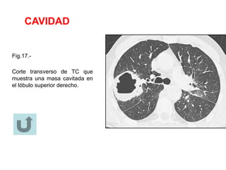 CAVIDAD
Fig.17.-
Corte transverso de TC que
muestra una masa cavitada en
el lóbulo superior derecho.
 
