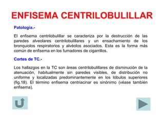 ENFISEMA CENTRILOBULILLAR
Patología.-
El enfisema centrilobulillar se caracteriza por la destrucción de las
paredes alveolares centrilobulillares y un ensachamiento de los
bronquiolos respiratorios y alvéolos asociados. Esta es la forma más
común de enfisema en los fumadores de cigarrillos.
Cortes de TC.-
Los hallazgos en la TC son áreas centrilobulillares de disminución de la
atenuación, habitualmente sin paredes visibles, de distribución no
uniforme y localizadas predominantemente en los lóbulos superiores
(fig.18). El término enfisema centriacinar es sinónimo (véase también
enfisema).
 