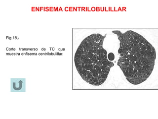 ENFISEMA CENTRILOBULILLAR
Fig.18.-
Corte transverso de TC que
muestra enfisema centrilobulillar.
 