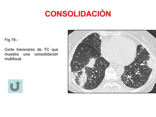 CONSOLIDACIÓN
Fig.19.-
Corte transverso de TC que
muestra una consolidación
multifocal.
 