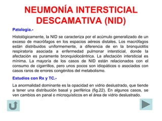 NEUMONÍA INTERSTICIAL
DESCAMATIVA (NID)
Patología.-
Histológicamente, la NID se caracteriza por el acúmulo generalizado de un
exceso de macrófagos en los espacios aéreos distales. Los macrófagos
están distribuidos uniformemente, a diferencia de en la bronquiolitis
respiratoria asociada a enfermedad pulmonar intersticial, donde la
afectación es puramente bronquiolocéntrica. La afectación intersticial es
mínima. La mayoría de los casos de NID están relacionados con el
consumo de cigarrillos, pero unos pocos son idiopáticos o asociados con
casos raros de errores congénitos del metabolismo.
Estudios con Rx y TC.-
La anormalidad dominante es la opacidad en vidrio deslustrado, que tiende
a tener una distribución basal y periférica (fig.22). En algunos casos, se
ven cambios en panal o microquísticos en el área de vidrio deslustrado.
 
