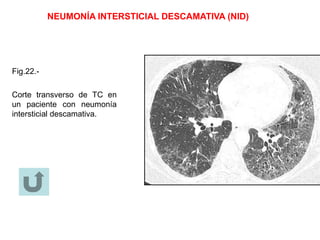 NEUMONÍA INTERSTICIAL DESCAMATIVA (NID)
Fig.22.-
Corte transverso de TC en
un paciente con neumonía
intersticial descamativa.
 