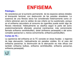 ENFISEMA
Patología.-
Se caracteriza por el aumento permanente de los espacios aéreos distales
al bronquiolo terminal, con destrucción de las paredes alveolares. La
ausencia de una fibrosis obvia fue considerada históricamente como un
criterio adicional, pero la validez de ese criterio se ha cuestionado, porque
en el enfisema secundario al consumo de cigarrillos puede existir algo de
fibrosis intersticial. Habitualmente se clasifica según la parte del acino
predominantemente afectada: proximal (centriacinar, más comúnmente
llamado enfisema centrilobulillar), distal (enfisema paraseptal) o del acino
completo (panacinar o, menos comúnmente, enfisema panlobulillar).
Cortes de TC.-
La apariencia del enfisema en la TC consiste en áreas focales o regiones
de baja atenuación, habitualmente sin paredes visibles. En el caso del
enfisema panacinar, la disminución de la atenuación es más difusa (ver
también enfisema bulloso, enfisema centrilobulillar, enfisema panacinar,
enfisema paraseptal).
 