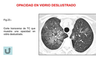 OPACIDAD EN VIDRIO DESLUSTRADO
Fig.23.-
Corte transverso de TC que
muestra una opacidad en
vidrio deslustrado.
 