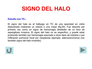 SIGNO DEL HALO
Estudio con TC.-
El signo del halo es el hallazgo en TC de una opacidad en vidrio
deslustrado rodeando un nódulo o una masa (fig.24). Fue descrito por
primera vez como un signo de hemorragia alrededor de un foco de
aspergilosis invasiva. El signo del halo no es especifico, y puede estar
producido también por hemorragia asociada a otros tipos de nódulos o por
infiltración pulmonar local por neoplasias (ejemplo, adenocarcinoma) (ver
también signo del halo invertido).
 